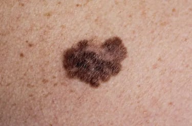 a close up of a person's skin cancerous skin cancerous skin cancer