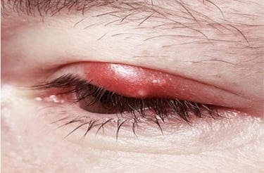 keluhan kelopak mata bengkak