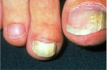 Penanganan Kuku Berjamur Klinik Sehat Plus BSD