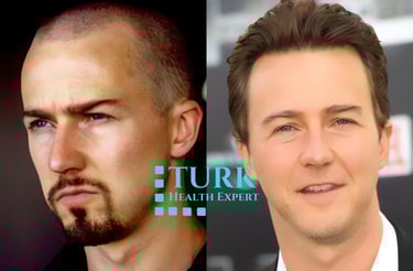 Edward Norton Hair Transplant