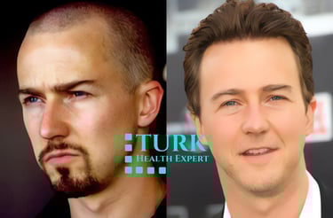 Edward Norton Hair Transplant clinic