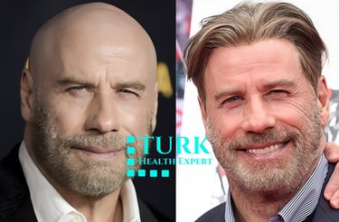  John Travolta has had a hair transplant