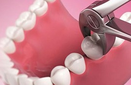 a dental model with extraction of a tooth