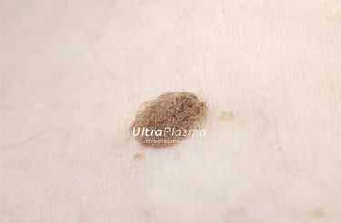 ultraplasma.com_seborrheik_keratosis_treatment_seboreik_keratoz_tedavisi_ultra_plasma_ultra_plazma