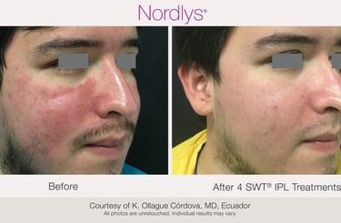 before and after redness and vascular treatment results in Hamilton clinic