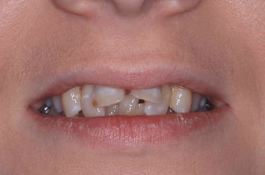 a close up of a person's mouth with mis aligned teeth