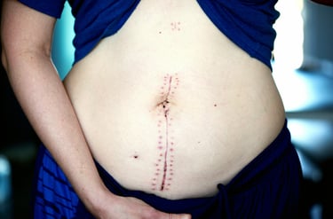 surgical incision scar