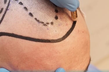 transplantation capillaire en Algérie, chirurgie esthétique cheveux Algérie, esthétique, جمالي, جمال