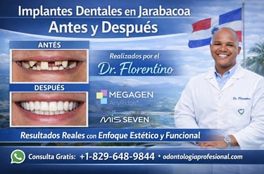 Implantes dentales en Jarabacoa antes y después realizados por el Dr. Florentino.