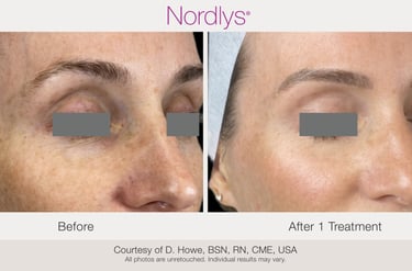before and after skin texture improvement treatment results in Hamilton clinic