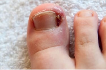 Penanganan Kuku Cantengan Klinik Sehat Plus BSD