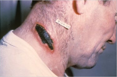 Anthrax lesion