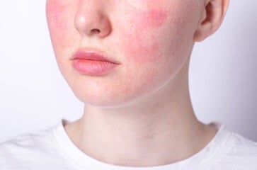 sensitive skin