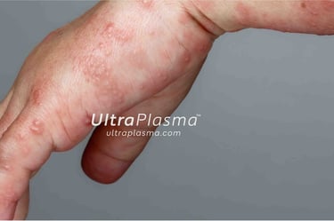 akne_acne_ultra_plasma_ultra_plazma_ultra-plasma_ultra-plazma