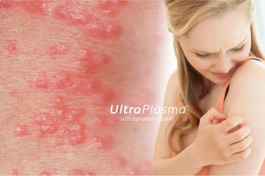ultraplasma.com_Sarcoptes_scabiei_Infestation_Treatment_ultra_plasma_ultra_plazma