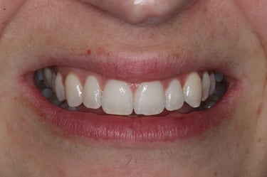 a close up of a person's teeth after invisalign aligner treatment