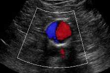 vascular ultrasound imaging perth corewave best artery vein treatment symptom scan doppler bulk bill doctor recommend near me