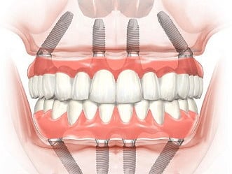 All-on-4 procedure
