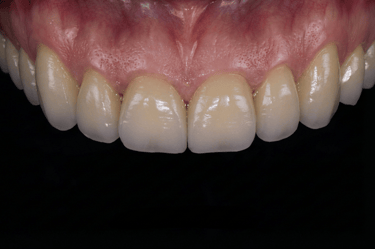 Close-up of a patient with natural-looking dental crowns and healthy pink gums.