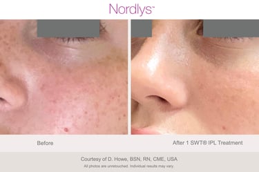 professional skin texture improvement treatment for smoother skin in Hamilton Ontario