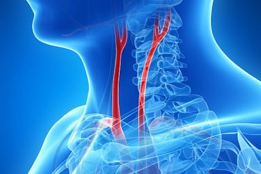 vascular ultrasound artery tia atherosclerosis plaque carotid doppler stroke dizziness stenosis stent disease vision headache