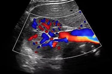 vascular ultrasound imaging perth corewave best vein artery treatment symptom scan doppler bulk bill doctor recommed near me