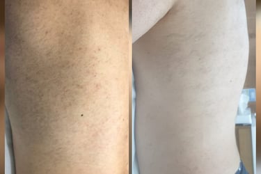 before and after one session laser
