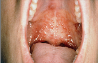 სამედიცინო დოკუმენტების თარგმნა - ჰერპეს ვირუსული ჰეპატიტი