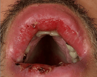 ვულგალური პემფიგუსი - სამედიცინო დოკუმენტების თარგმნა