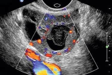 Ultrasound image of ovary with color Doppler in hands-on transvaginal training class.