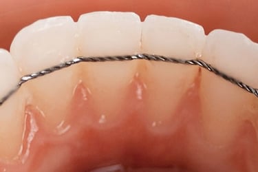  LA CONTENTION : L'ÉTAPE CLÉ POUR STABILISER VOTRE SOURIRE