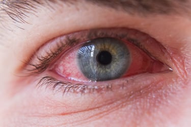 Relief for inflamed red eye
