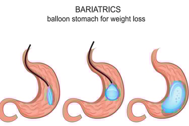 illustration of gastric ballon