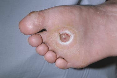 diabetic foot ulcer