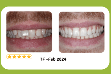 Before and after dental treatment showing teeth straightening and professional whitening results.