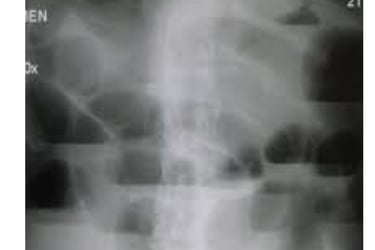 القيء من انسدادات الجهاز الهضمي العلوي