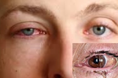 Conjunctivitis