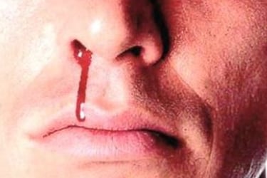 Epistaxis Natural Remedi - fasting