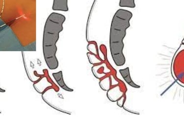 Home treatment of fistula My experience in treating fissures