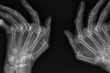 Stages of Rheumatoid Arthritis