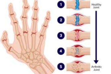Rheumatoid Arthritis stages