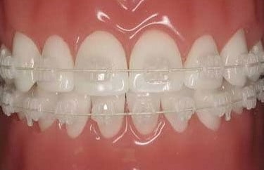 Brackets de Cerámica (Cortesía de 3M Unitek)