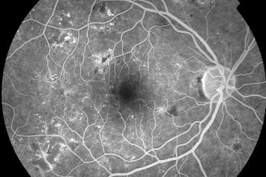 non prolific diabetic retinopathy