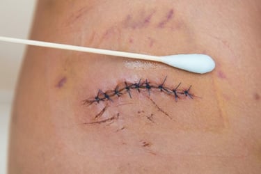 Applying ointment with a cotton swab to a surgical incision closed with blue stitches for wound care.