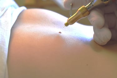 Dermatologist performing professional laser mole removal procedure on a patient's skin.