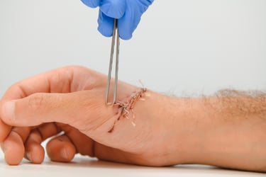 A doctor using tweezers to perform suture removal on a healing hand incision.