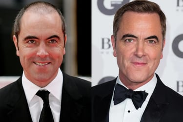 hair transplant james nesbitt