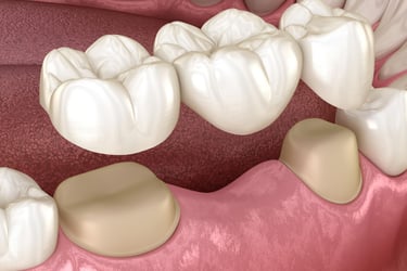 dental bridges
