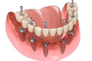 All on six dental implants