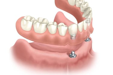 Sobredentadura inferior dos implantes